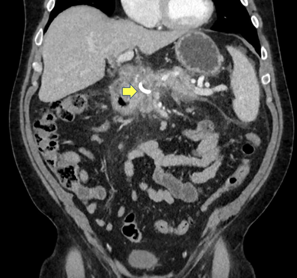 <b>Figure 2: Post-cystgastrostomy (yellow arrow) decompression of pseudocyst with resulting relief of biliary obstruction</b>