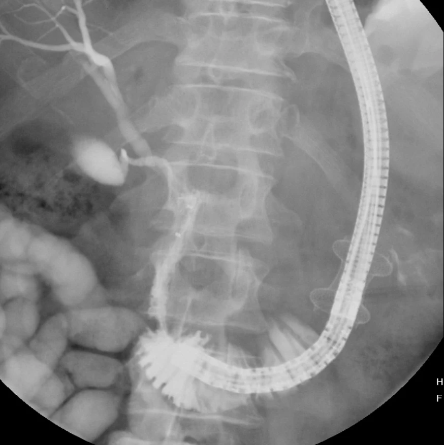 Flouroscopic image of ERCP performed through endoscopic ultrasound-guided gastrojejunostomy lumen apposing stent.