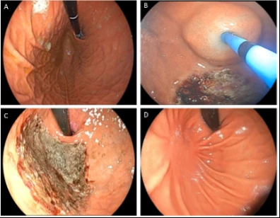 <b>Figure 1. Endoscopic fundus mucosal ablation. </b>A. Gastric fundus prior to fundic mucosal ablation (FMA). B. Submucosal lift of gastric fundic tissue. C. Gastric fundus immediately after FMA. D. Gastric fundus 6 months after FMA.