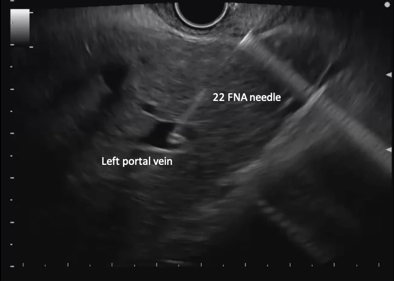 Endoscopic ultrasound image of needle puncture of the left portal vein with a 22G fine needle aspiration needle.
