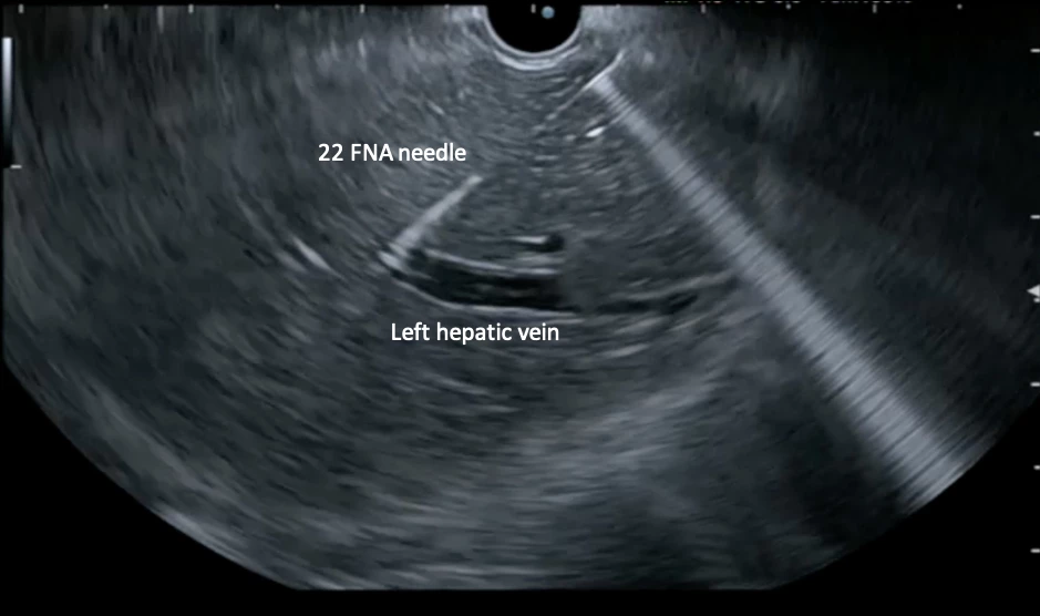 Endoscopic ultrasound image of needle puncture of the left hepatic vein with a 22G fine needle aspiration needle.