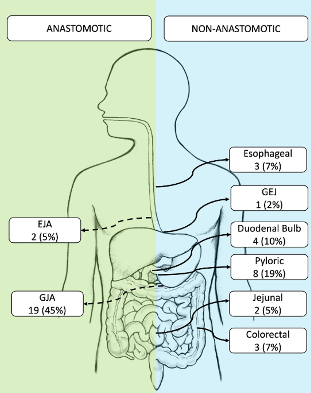 Fig 1. Localization of benign GI strictures of the included patients. GEJ: gastroesophageal junction; EJA: esophagojejunal anastomosis; GJA: gastrojejunal anastomosis.