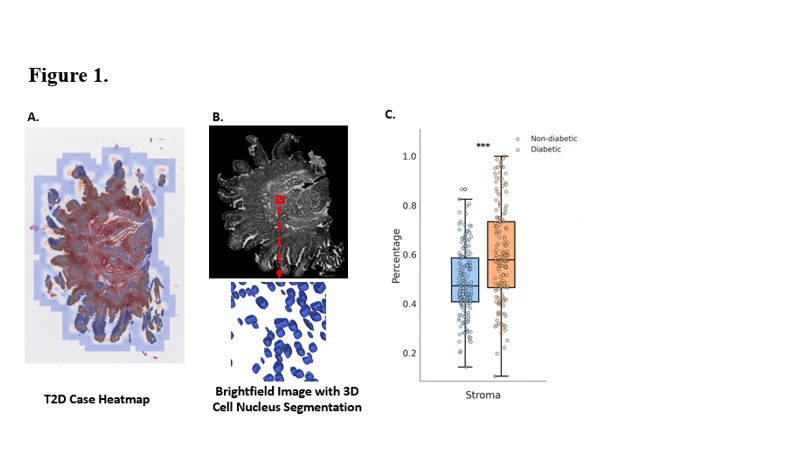 <b>Figure 1. </b>A) Heatmap displaying lymphocyte hotspots and lamina propria stroma expansion (shown in red) associated with T2D, B) Brightfield image showing 3D reconstruction and cellular segmentation of the lamina propria, C) Box plot illustrating increased lymphocyte hotspots and lamina propria expansion in T2D.
