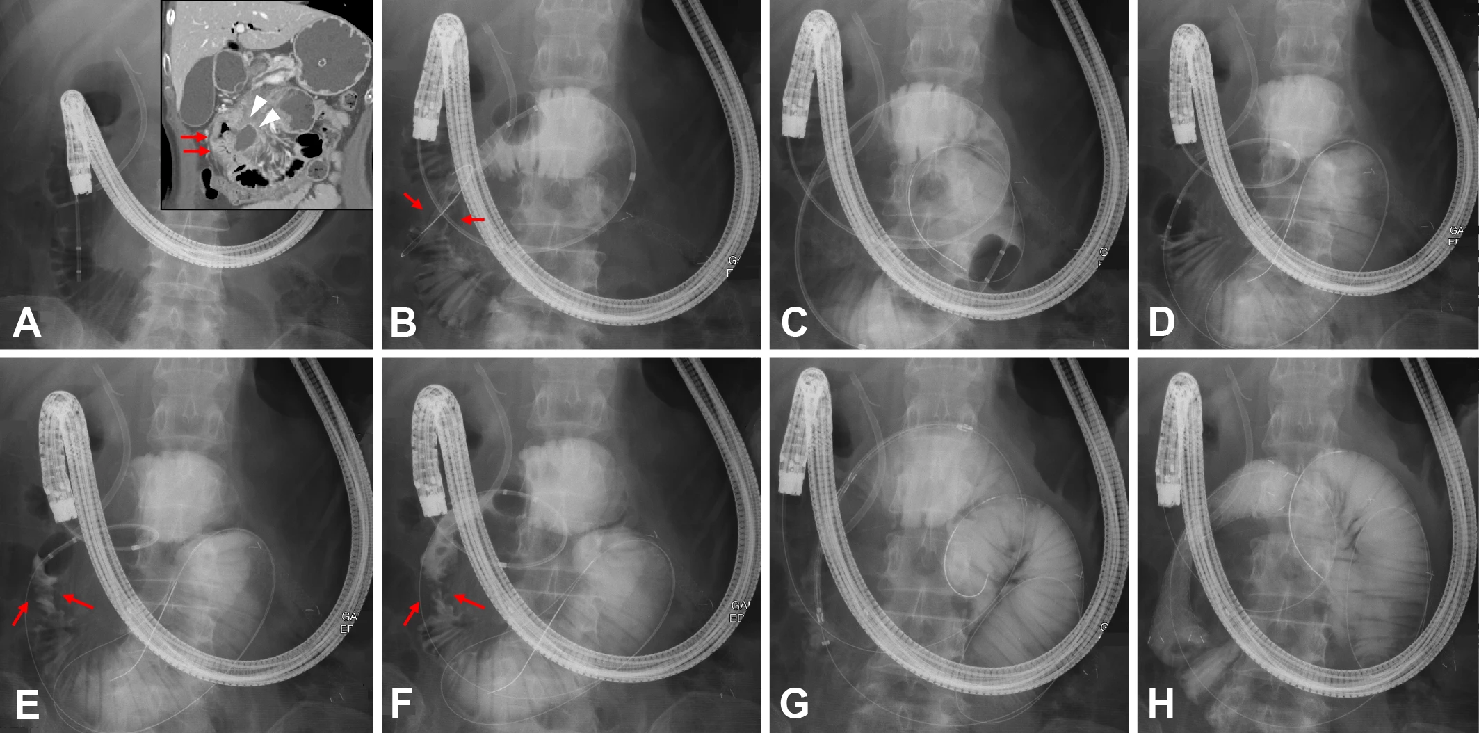 Stone extraction balloon catheter-assisted endoscopic stenting for malignant proximal jejunal obstruction caused by a malignant mesenteric lymph node (red arrows: jejunal obstruction; white arrowheads: mesenteric lymph node).