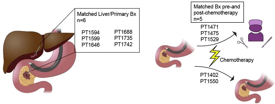 Inferred CNV profile of our institutional single cell RNA sequencing cohort using the Numbat pipeline.