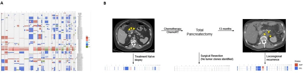 Inferred CNV profile of patient 1475 at time of treatment naïve diagnostic biopsy (left) and at locoregional recurrence more than a year after total pancreatectomy (right).  Profiling of resected tumor specimen at time of pancreatectomy did not show any tumor cells captured and pathologist examination of tissue showed near complete response to therapy.
