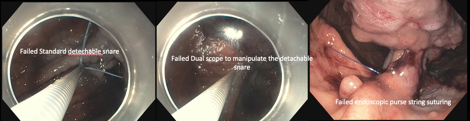 Image 1: Failed standard detachable snare, dual scope manipulation and endoscopic purse string suturing