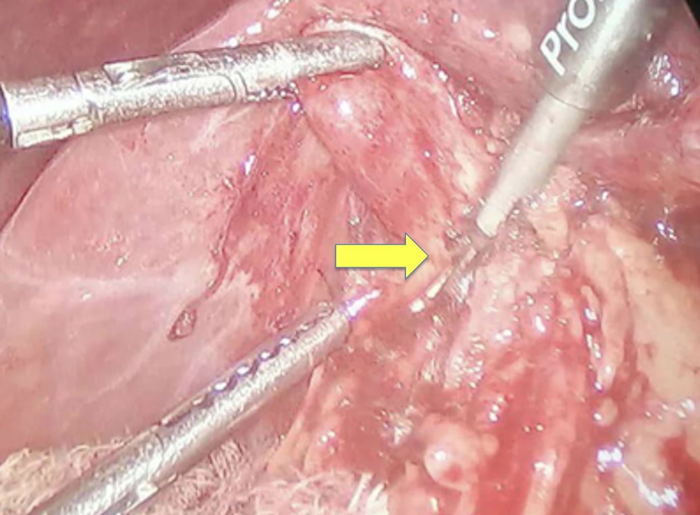 Dense pericholecystic adhesions in delayed laparoscopic cholecystectomy