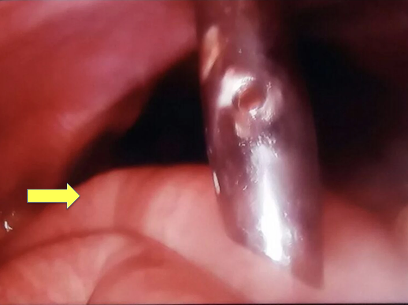 Distended bowel in immediate laparoscopic cholecystectomy