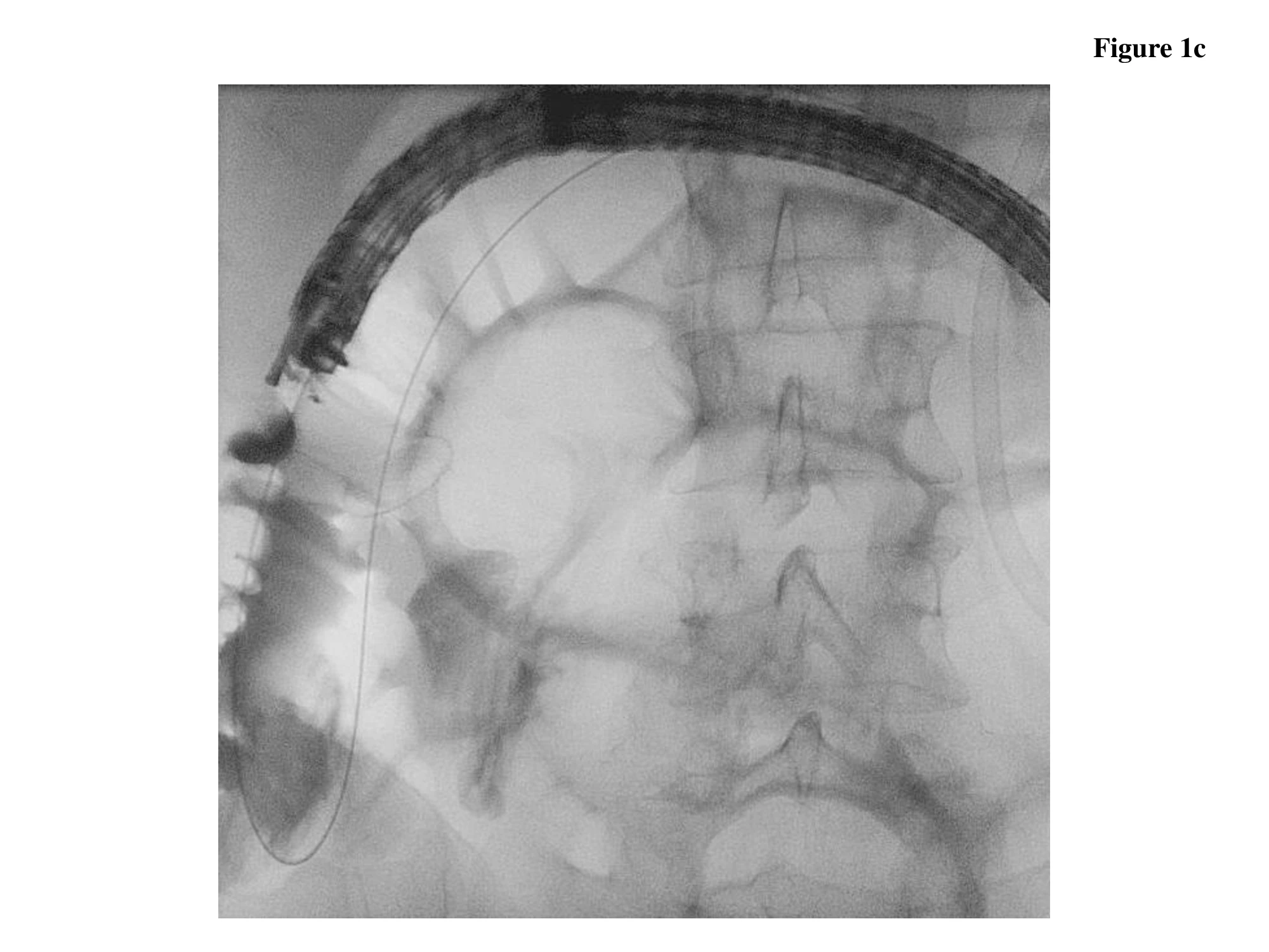 LAMS successfully deployed under fluoroscopic guide between the target distal ileum and the right colon. Technical success is then confirmed by passage of contrast through the LAMS into the distal ileum with no extraluminal spilling.