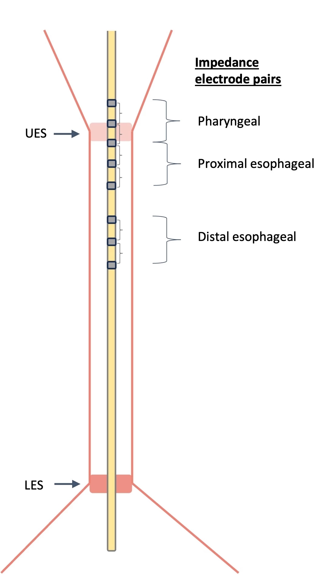 Figure 1. The hypopharyngeal-esophageal multichannel intraluminal impedance and pH catheter contains 6 impedance electrodes pairs, divided into pharyngeal (3 and 1 cm above UES and 1 cm below UES), proximal esophageal (1, 3 and 5 cm below UES), and distal esophageal (9, 11, and 13 cm below UES).