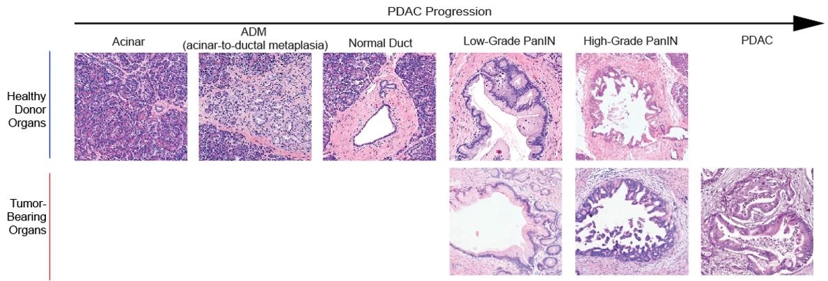 Histological structures identified in healthy donor pancreas and tumor-bearing pancreas delineating the progression of benign to malignant states in pancreatic cancer.