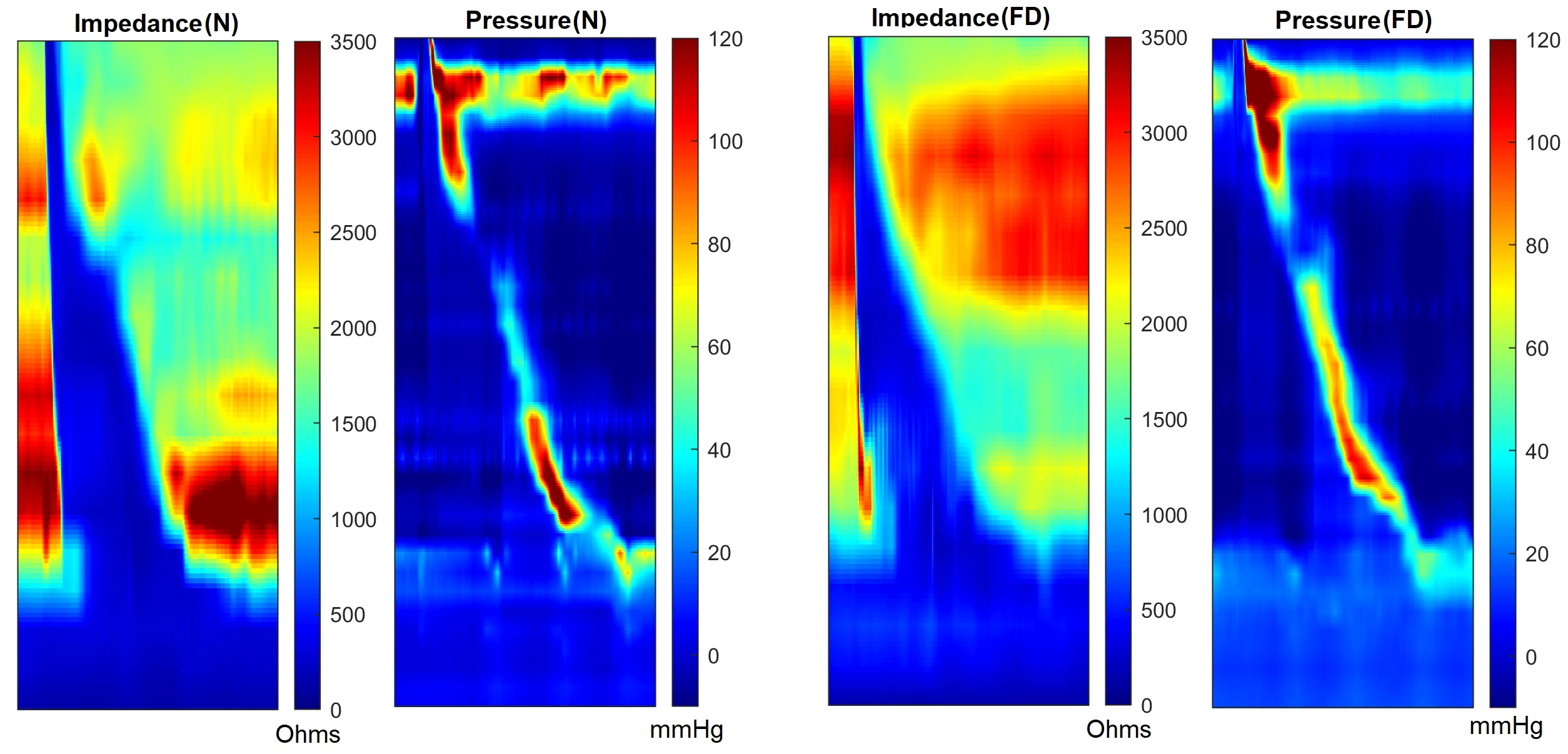<b>Figure 1. </b>Sample Impedance and Pessure heatmaps of a normal subject and a functional dysphagia patient.