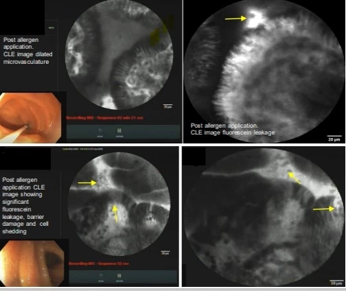 Fig1. CLE image showing fluorescein leakage and cell-shedding post allergen exposure.