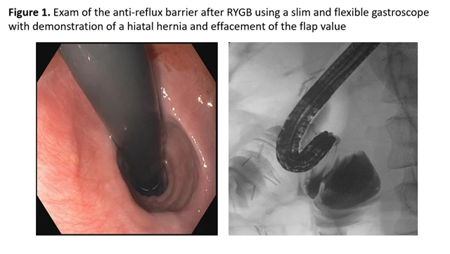 Figure 1 - Exam of the anti-reflux barrier after RYGB using a slim and flexible gastroscope with demonstration of a hiatal hernia and effacement of the flap valve
