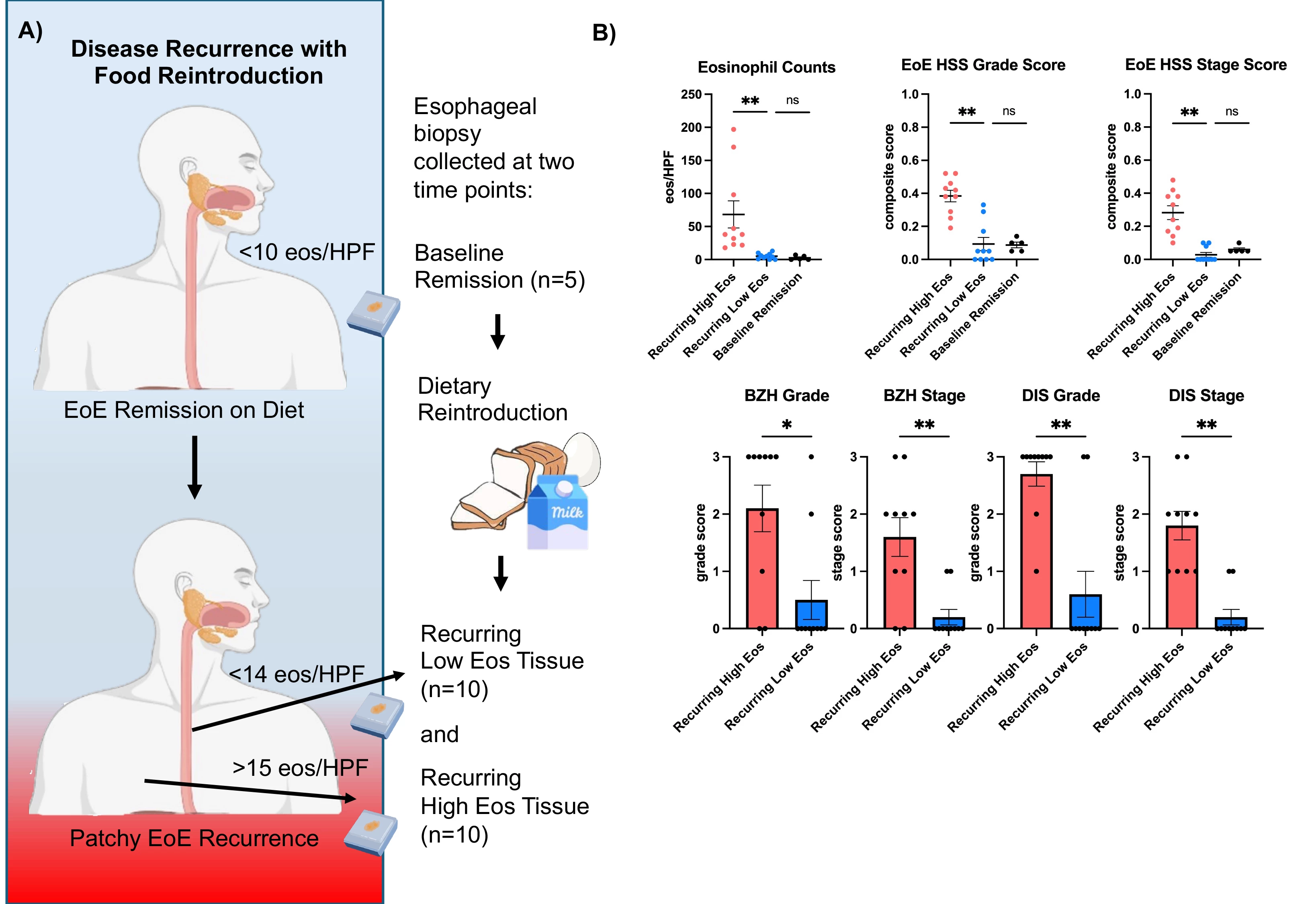 <b>Figure 1. A)</b> Study design of tissue collection and sequencing performed on the following: (1) baseline remission tissue of elimination diet where the trigger is removed (n=5, ≤10 eos/HPF), (2) patchy disease recurrence (n=10) following food reintroduction. These specimens were categorized into (2a) “recurring high eos tissue” with active disease (≥15 eos/HPF) and (2b) “recurring low eos tissue” (<13 eos/HPF). (3) non-EoE controls (n=22). <b>B)</b> Recurring high eos tissue had greater EoE Histology Scoring System (EoEHSS) grade and stage compared to low eos tissue (p<0.01). Specifically, high eos tissue had more severe and extensive basal zone hyperplasia and dilated intercellular spaces.