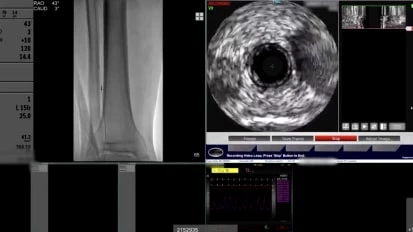PAD Live: Strategies for success with IVUS, laser, atherectomy, and definitive treatment