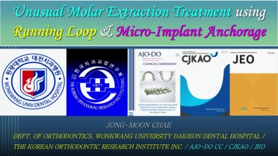 Thumbnail for Unusual Molar Extraction Treatment using Running Loop and Micro-Implant Anchorage (MIA)