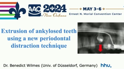 Thumbnail for Forced Extrusion of Ankylosed Teeth using Periodontal Extrusion