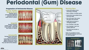 Thumbnail for 16" x 20" Unframed Wall Art, Periodontal Disease Chart