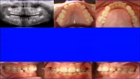 Thumbnail for Point/Counterpoint: Extraction in the Mixed Dentition -- A Reasonable Option for Selected Patients?