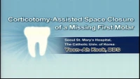 Thumbnail for Corticotomy-assisted Accelerated Space Closure of a Missing Molar by Utilizing the Third Molar