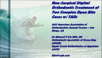 Thumbnail for Non-Surgical Digital Orthodontic Treatment of Two Complex Open Bite Cases with TADs