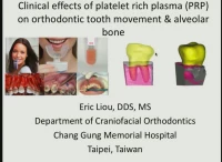 Thumbnail for Clinical Effects of Platelet Rich Plasma on Alveolar Bone and Orthodontic Tooth Movement