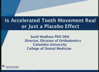 Thumbnail for Is Accelerated Tooth Movement Real or Just a Placebo Effect?