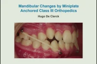 Thumbnail for Mandibular Changes by Miniplate Anchored Class III Orthopedics