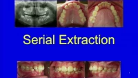 Thumbnail for Serial Extraction: Beyond the Basics