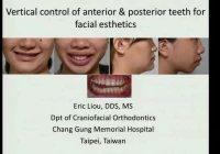 Thumbnail for Vertical Control of Anterior and Posterior Teeth for Facial Esthetics
