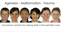 Thumbnail for Uncommon Solutions for Missing Teeth: Dare to Think Differently!