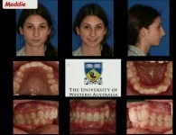 Thumbnail for 2017 AAO Annual Session - Temporary Anchors and Surgical Orthodontics / Rotations of the Maxilla and the Occlusal Plane: The Key to Successful Orthopedics / Revisiting Malocclusions with Mini-implants 