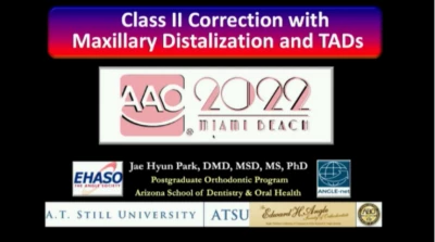 Thumbnail for Class II Correction with Maxillary Distalization & TADs