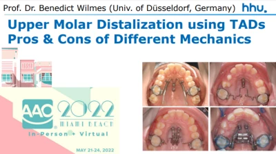 Thumbnail for Upper Molar Distalization using TADs: Pros & Cons of Different Mechanics