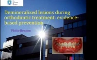 Thumbnail for 2016 AAO Annual Session - Demineralized Lesions During Orthodontic Treatment: Evidence-based Prevention / Deproteinization of Tooth Enamel Surfaces to Prevent White Spot Lesions and Bracket Bond Failure: A Revolution