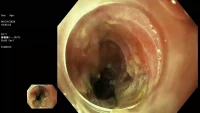 Thumbnail for ASGE Video Plenary - Session IV