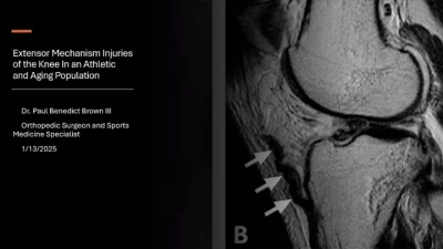 Thumbnail for Injuries to the Extensor Mechanism of the Knee in the Athletic and Aging Population