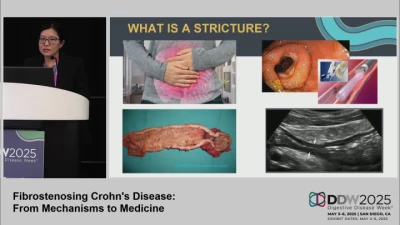Thumbnail for Fibrostenosing Crohn's Disease: From Mechanisms to Medicine